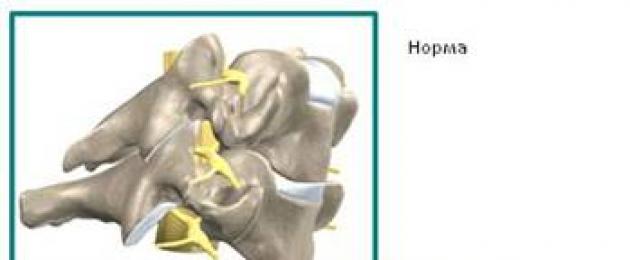 Причины появления боли в шее (в шейном отделе): методы лечения. Лечение болей в шее Центр болей в шее