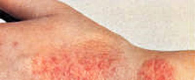 Eruzioni allergiche negli adulti.  Cause di eruzioni cutanee pruriginose.  Quando è necessario chiamare urgentemente un medico?