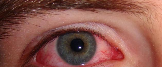 Аллергия на контактные линзы: причины и проявления. Контактные линзы и аллергия