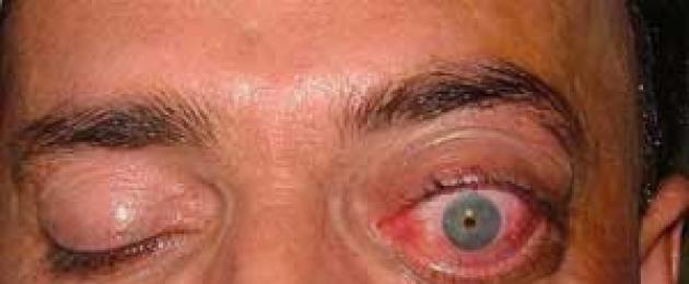 Болезнь когда глаза выпучены. Экзофтальм — что это такое? Диагностика и лечение экзофтальма