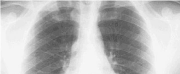 Metodi di esame di pazienti con tubercolosi.  Diagnosi di tubercolosi polmonare e metodi di esame nelle fasi iniziali Metodi per la diagnosi precoce della tubercolosi