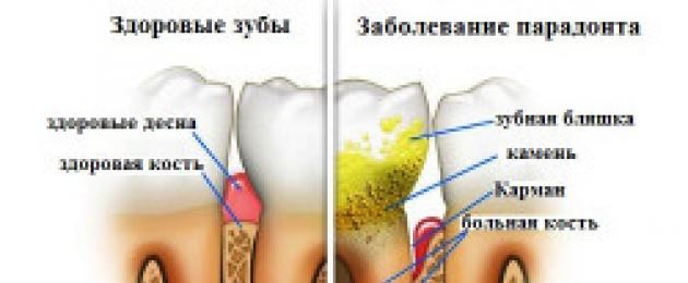 Оголение шейки зуба лечение. Помогут ли народные средства «вернуть» десну на место? Прогноз на выздоровление