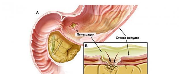 La complicanza più comune delle ulcere allo stomaco.
