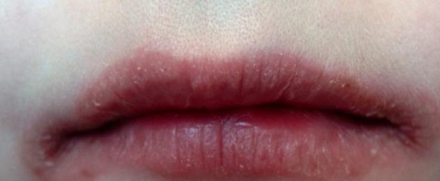 Красная губа внутри. Раздражение и покраснение вокруг рта - возможные причины и особенности лечения