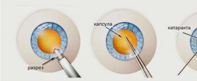 Факоэмульсификация катаракты. Ультразвуковая факоэмульсификация катаракты Что значит фэк