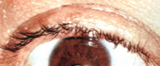 Cosa fare con prurito e bruciore intorno agli occhi?  Sensazione spiacevole di bruciore agli occhi: cause e trattamento Bruciore agli occhi.