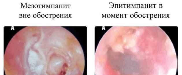 التهاب الأذن الوسطى الحاد رمز الميكروبي.  التهاب الأذن الوسطى الحاد