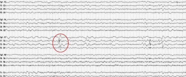 EEG: cos'è questo studio.  Cosa mostra l'elettroencefalografia della testa e come decifrare i risultati