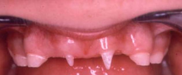 Зуб вырос вторым рядом. Что делать, если зубы растут в два ряда? Постоянный зуб лезет сзади молочного: симптомы и диагностика