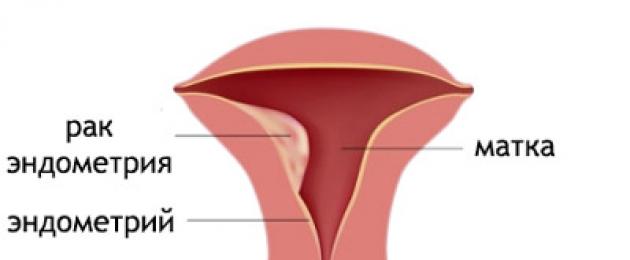 От чего может быть рак матки. Когда показана гормонотерапия рака тела матки? Влияние факторов на продолжительность жизни