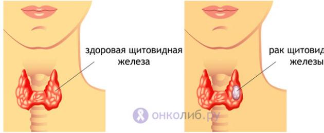 Первые признаки и лечение рака щитовидной железы у женщин и мужчин. Симптомы, диагностика и лечение опухоли щитовидки