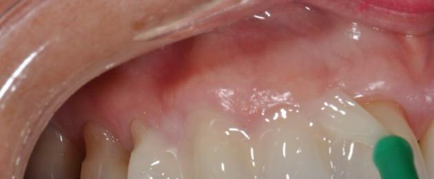 Зачем необходима процедура реминерализации зубов? Что такое реминерализация зубов Зубная паста для минерализации эмали. 