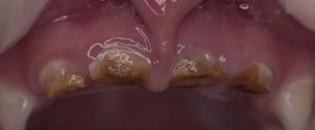 Причины появления гнилых зубы и способы их лечения. Почему гниют зубы: причины, возможные заболевания, методы лечения, профилактика