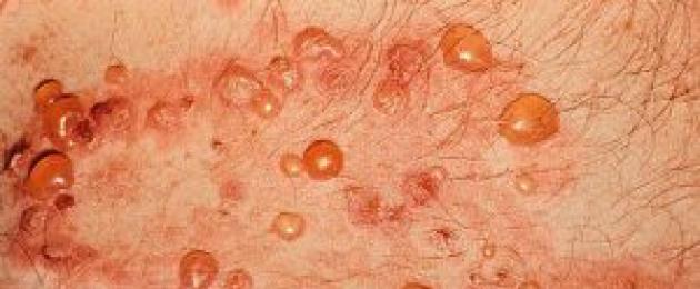 Dermatite esfoliativa bollosa.  La dermatite bollosa è una malattia acuta della pelle.