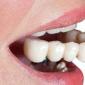 Prótesis en ausencia de un gran número de dientes: elegir la mejor prótesis para la edentia parcial o completa Prótesis en ausencia de dientes