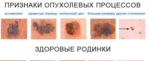 Cos'è il melanoma.  Il trattamento dipende dallo stadio di sviluppo della malattia