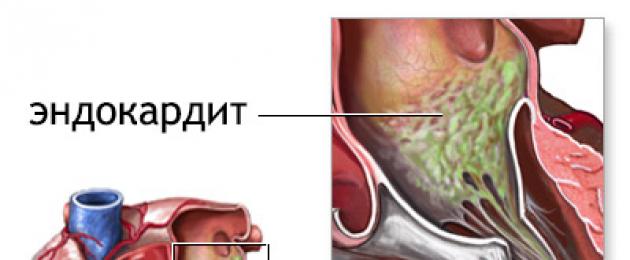 Endocardite infettiva subacuta della valvola aortica.  Cosa sono i nodi di Osler?  Cause di comparsa, patogenesi, trattamento