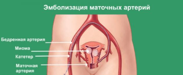 Tecnica di embolizzazione dell'arteria uterina.  Embolizzazione dell’arteria uterina (UAE) come trattamento per i fibromi uterini