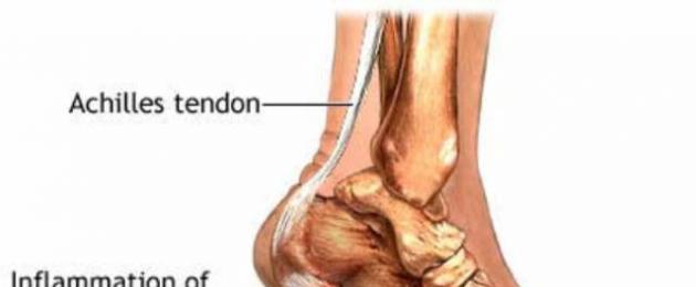 Причины боли в области сухожилия над пяткой и способы лечения. Сухожилия ноги