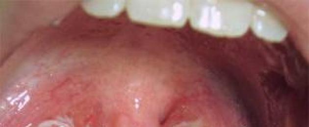 Come procede la tonsillite purulenta.  Procedura passo passo per rimuovere il pus dalle tonsille