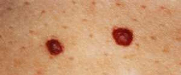 Мелкие пупырышки по всему телу. Красные точки на теле: причины, лечение, профилактика
