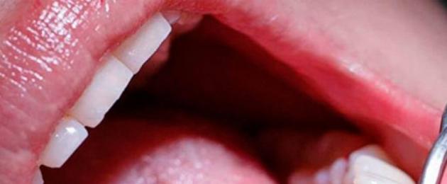 Perché le caramelle fanno male ai denti.  I denti fanno male a causa dei dolci: per quale motivo e come affrontarlo
