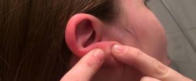 Почему может появиться шишка в мочке уха? Что делать, если в мочке уха образовался шарик. 