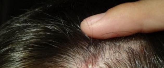 Herpes sotto i capelli: cos'è e come trattarlo?  Un approccio integrato al trattamento.  Cause della malattia