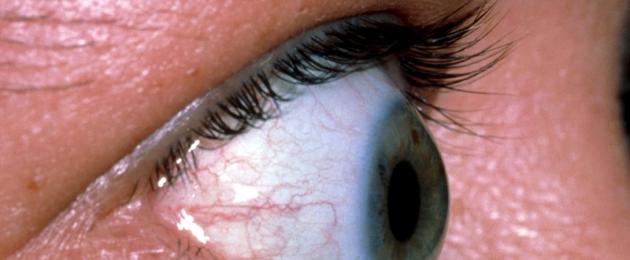 Выпячивание глазного яблока. Экзофтальм - что это такое? Смещение глазного яблока вперед (выпученные глаза): причины и лечение