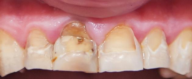 Клиновидный дефект зубов по мкб 10. Клиновидный дефект твердых тканей зубов: что делать, как лечить, реставрация