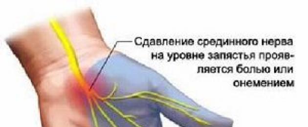 Горит запястье. Сдавление срединного нерва на уровне запястья. Физиотерапия запястного канала. Синдром компрессии срединного нерва. Срединный нерв на уровне запястья.