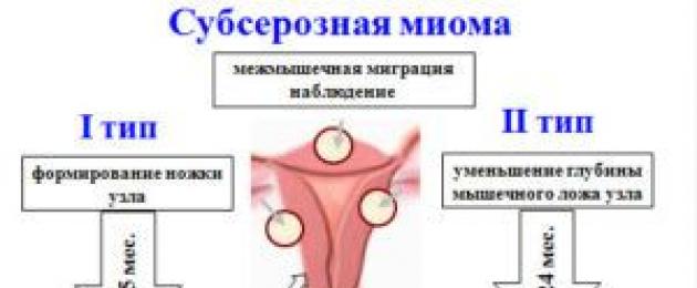 Субсерозная лейомиома матки лечение. Симптомы и лечение лейомиомы и фибромиомы матки