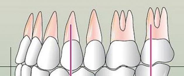 occlusione centrale.  Occlusione dentale: tipologie, sintomi, trattamento Cos'è l'occlusione centrale