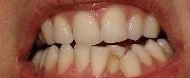 Когда у детей выпадают первые зубы. В каком возрасте и в каком порядке выпадают молочные зубы у детей