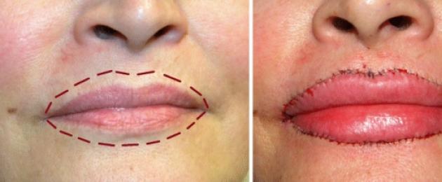 Allarga le tue labbra in modo permanente senza intervento chirurgico.  Come allargare le labbra a casa?  Esercizi utili per aumentare il volume delle labbra