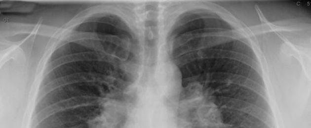 Cambiamenti polmonari nella sarcoidosi.  Sarcoidosi polmonare: sintomi, trattamento e prognosi