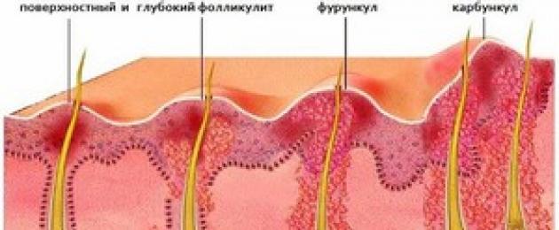 Лечение фурункула в паху у женщин. Фурункул на гениталиях у женщин
