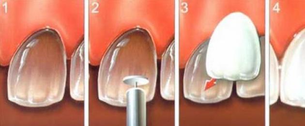 Реставрация режущего края фронтальных зубов. Художественная реставрация зубов: цена, методы, фото