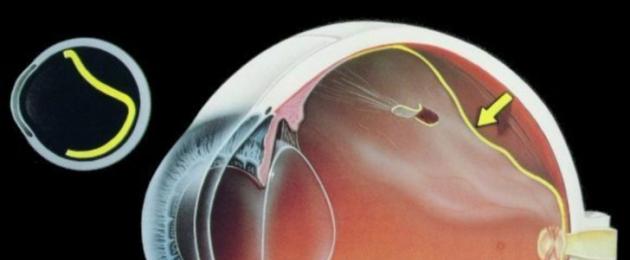 Quanto è comune la retinopatia nei neonati prematuri?  Retinopatia del prematuro: esiste la possibilità di avere una buona vista?  Saremo felici di aiutare i tuoi figli