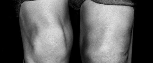 Синовит коленного сустава: симптомы и лечение. Особенности лечения синовита лучезапястного сустава
