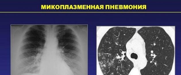 Polmonite da micoplasma (pneumoniae): micoplasmosi respiratoria polmonare delle vie respiratorie, bronchite.  Bronchite acuta da Mycoplasma pneumoniae (J20.0) Trattamento del micoplasma polmonare