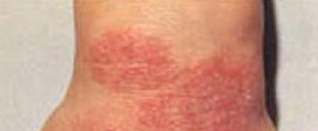 Perché l'eczema.  Cos'è l'eczema?  Stadio acuto dell'eczema idiopatico