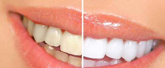 Все про реминерализацию зубов: современный способ поддержания здоровья эмали. Проверенные методы реминерализации эмали зубов Препараты для реминерализации зубов у детей