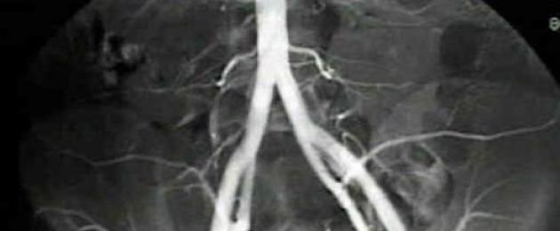 Внутренняя подвздошная артерия обеспечивает кровью. Что такое окклюзия подвздошных артерий и чем она опасна? Висцеральные ветви внутренней подвздошной артерии