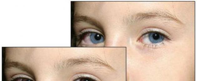 Может ли у человека поменяться цвет глаз. Почему меняется цвет глаз у взрослого человека