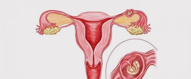 Quanto è pericoloso il fluido nel fornice posteriore dell'utero.