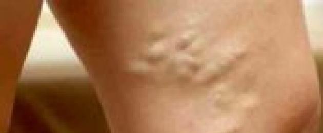 Vene nodulari sulle gambe.  Le vene varicose rappresentano una vera minaccia per la salute.  Perché si sviluppano le vene varicose?