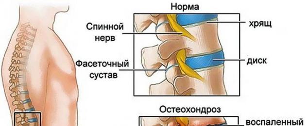 Da dove viene il dolore con l'osteocondrosi cervicale?  Dove va il dolore nell'osteocondrosi cervicale, lombare e toracica?  Aumenti di pressione sanguigna