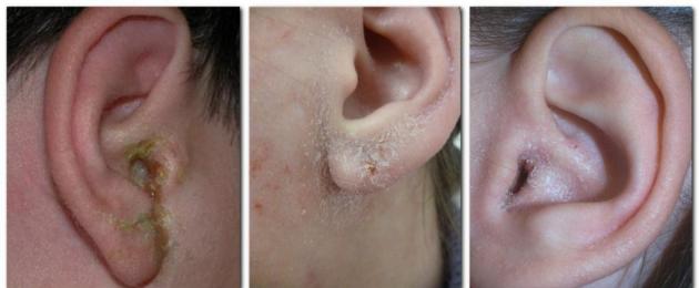 Сухость и шелушение в ушах – первый звоночек, который не стоит пропускать. Уши чешутся и шелушатся