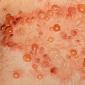 Буллезный дерматит – острое заболевание кожных покровов
